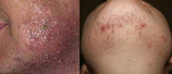 Ingrown hair can also vary in size. Ingrown Hair On Face How To Get Rid Removal Prevent Beard Chin Facial For Women Men