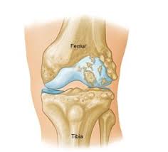Weak muscles are a leading cause of knee injuries. Lateral Knee Pain Diagnosis Treatment Knee Pain Explained