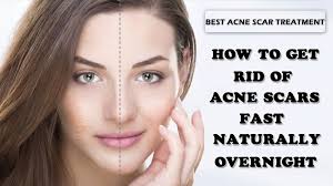 A>, which is designed to both instantly conceal and treat to reduce blemishes. Get Rid Of Acne Scars Fast How To Get Rid Of Acne Scars Fast Naturally Overnight Video Dailymotion