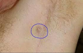 Attacking it with your tweezers is likely to create or worsen an infection. Lump Under Armpit Painful Hard Male Female Sore Small Red Swollen Tender Lump In Armpit Hurts In 2020 Ingrown Hair Armpit Lump Armpits