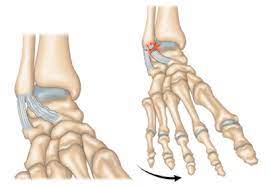 La cheville prend le poids du corps en marchant. Pathologie Ligamentaire Cheville L Ircos