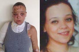 Acid attack victim recalls horrific moment boy, 15, chucked a bottle filled  with chemicals at her face and says she 'doesn't go out anymore'