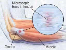 This is most often known as tennis elbow. Tendonitis Guide Causes Symptoms And Treatment Options