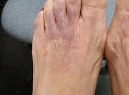 Dermatitis Alergica De Contacto Al Calzado Multiples Sensibilizaciones A Proposito De Un Caso Piel L Latinoamericana