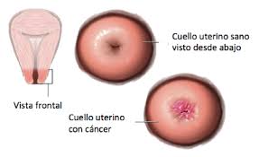 No entanto, para chegar ao diagnostico correto é preciso fazer uma série de exames para descartar outras hipóteses. Prevencion Deteccion Precoz Diagnostico Y Tratamiento Del Cancer Genital Cuidamos De La Mujer