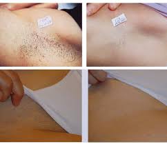 Hair With Color And Some Coarseness Is Well Suited For Permanent Removal Make Sure That The Lase Hair Removal Laser Hair Removal Best Hair Removal Products