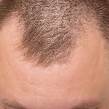 Image result for Alopecia