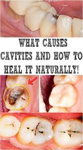 What Causes Cavities And How To Heal It Naturally Healthy Teeth Teeth Health Dental Health