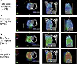 Medically reviewed by top mesothelioma doctors. Consensus Statement On Proton Therapy In Mesothelioma Practical Radiation Oncology