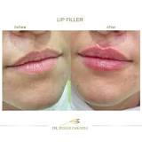 Best Filler in Egypt and Fifth Settlement - Dr Rehab Zakaria
