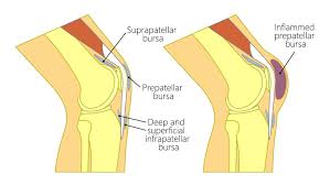 Image result for Prepatellar Bursitis