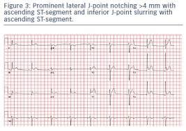 Image result for Early Repolarization