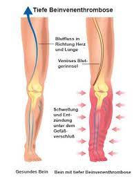 Postthrombotisches Syndrom Chronisch Venose Insuffizienz Gesundheitsportal