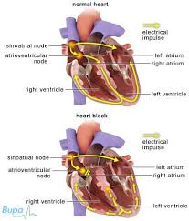 Image result for Atrioventricular Block