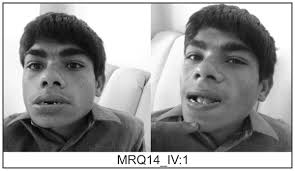 Exome Sequencing Identifies Three Novel Candidate Genes Implicated in  Intellectual Disability