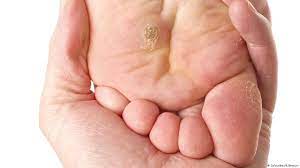 علاج الثآليل بمواد منزلية منوعات نافذة dw عربية على حياة المشاهير والأحداث الطريفة dw 22 10 2015