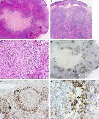 It preferentially affects the elderly and carries a poor prognosis, with a median survival of less than three years (15). Angioimmunoblastic T Cell Lymphoma With Hyperplastic Germinal Centres A Neoplasia With Origin In The Outer Zone Of The Germinal Centre Clinicopathological And Immunohistochemical Study Of 10 Cases With Follicular T Cell Markers Modern