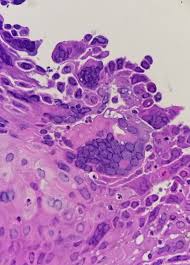 However, charateristic histologic findings of multinucleated giant cells with chromatin margination and cowdry a intranuclear inclusions were not readily apparent. Abdullah Alswied On Twitter Beautiful Example Of Herpes Esophagitis Pathology Gipath Pathresidents