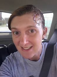 Skin graft from groin area