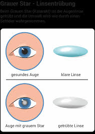 Gruner Star Grauer Star Amd Symptome Behandlung