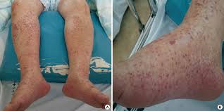 Trauma is the primary cause of petechiae spots on the legs, as well as other parts of the body. A Case Of Elderly Onset Crescentic Henoch Schonlein Purpura Nephritis With Hypocomplementemia And Positive Mpo Anca