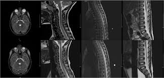 Image result for Myelitis