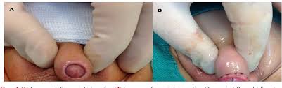 Image result for Phimosis