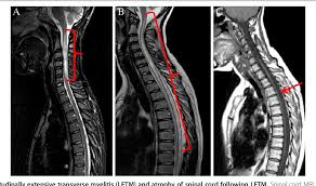 Clinical characteristics and magnetic resonance imaging (mri) of the spinal transverse myelitis (tm) is a pathogenetically heterogeneous focal inflammatory disorder of the spinal cord characterized. Figure 4 From Modifications Of Longitudinally Extensive Transverse Myelitis And Brainstem Lesions In The Course Of Neuromyelitis Optica Nmo A Population Based Descriptive Study Semantic Scholar