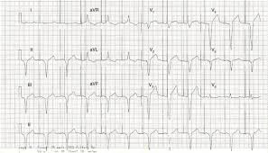 El electrocardiograma evalúa el ritmo y la función cardiaca a través de un registro de la actividad eléctrica del corazón, por lo que su médico le informará de los resultados del electrocardiograma y le indicará si precisa de nuevas revisiones o la realización de otros procedimientos. Electrocardiograma De Superficie En Pacientes Con Dispositivos De Estimulacion Cardiaca Sciencedirect