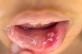 Blisters on the tongue or other parts of the body will often feel like a bump or a pimple. Mouth Ulcers And Cold Sores What S The Difference