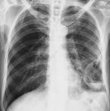 Image result for Lung Abscess