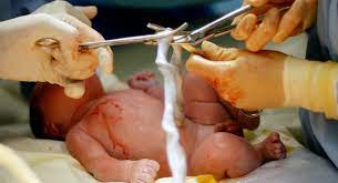 Delayed Cord Clamping Benefits Babycenter