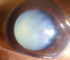 Image result for Cataract Extraction