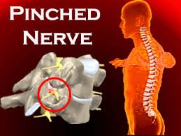 A pinched nerve will often need to be treated by your chiropractor, but you can try these other treatments of course, your body will take longer to heal if you aren't eating a healthy diet. Pinched Nerve Physical Therapy Can Help Fast Bridle Trails Pt