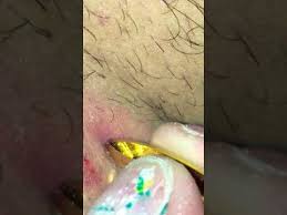 Ingrown hairs cause red, often itchy bumps where a hair has grown back into the skin. Satisfying Deep Ingrown Hair Removal Youtube