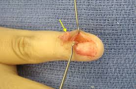 Image result for Glomus tumor