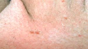 Image result for genital warts