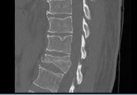 Image result for Calcaneus Compression Fracture