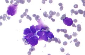 Tending to infiltrate, metastasize, and terminate fatally. Carcinoma Wikipedia