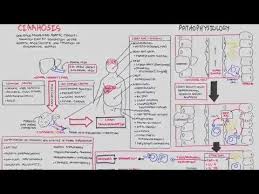 Liver Cirrhosis Sands Pathophysiology Investigations Management Cirrhosis Oral Pathology Nursing School Tips