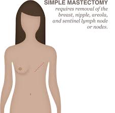 Irritation or dimpling of breast skin. Breast Cancer Treatment Options National Breast Cancer Foundation