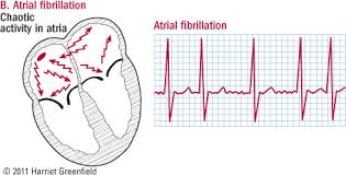 atrial fibrillation common serious treatable harvard health