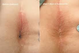 Image result for itchy skin rectum