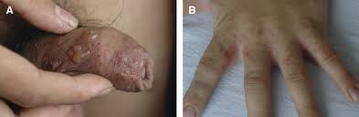 Because scabies spreads so easily, your doctor will likely recommend treatment for all household members and other close contacts, even if they show no signs of scabies infestation. Bullous Scabies In The American Journal Of Tropical Medicine And Hygiene Volume 95 Issue 3 2016