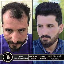 Million Hair Center Sac Ekim Merkezi