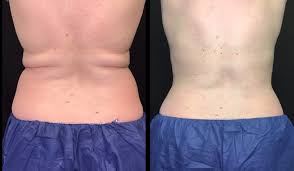 This image shows coolsculpting of the abdomen, before and eight weeks after. Coolsculpting Elite Aurora Co Cool Sculpting Cost Denver Co