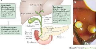 They are also known as bile duct stones or gallstones in the bile duct. Gallstones Nature Reviews Disease Primers