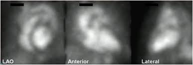 Image result for Nuclear Ventriculogram