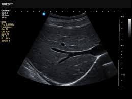 When finished, you can close the command prompt if you like. Ultrasound Images Liver B Mode 638 H60