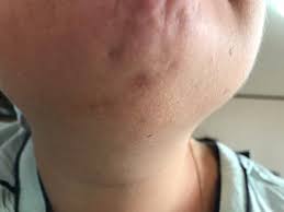 Having stray facial hairs is very common for women, says arash akhavan, md, a new york city. Pcos Facial Hair Electrolysis How I Deal With It Hirsutism My Pcos Kitchen